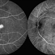 Macular Telangiectasia Type 2 &  CNV Macular Telangiectasia Type 2 &  CNV